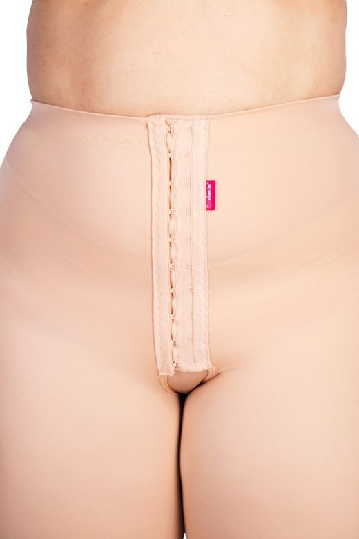 Lipoelastische Miederhose nach einer Liposuktion bei Lipödem
