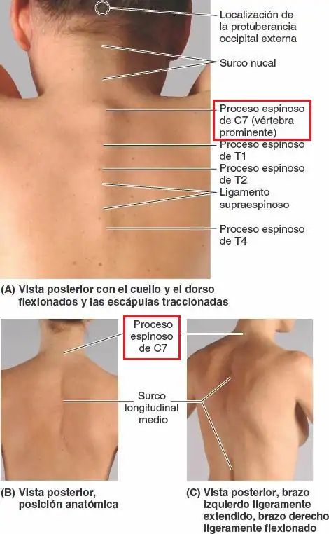 Spinomed® Rückenorthese bei Osteoporose