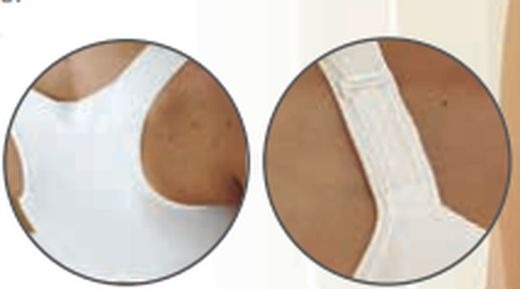 Mirabelle Mastektomie-BH und Brustprothese